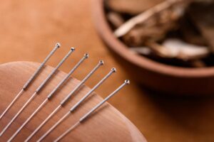 Why Acupuncture Is Becoming A Must-Have In Executive Wellness Programs